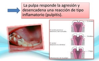 La pulpa responde la agresión y
desencadena una reacción de tipo
inflamatorio (pulpitis).
 