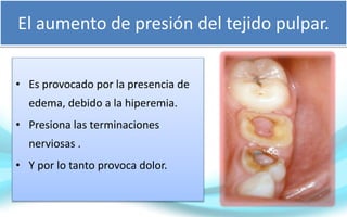 El aumento de presión del tejido pulpar.
• Es provocado por la presencia de
edema, debido a la hiperemia.
• Presiona las terminaciones
nerviosas .
• Y por lo tanto provoca dolor.
 