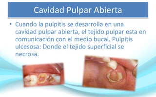Cavidad Pulpar Abierta
• Cuando la pulpitis se desarrolla en una
cavidad pulpar abierta, el tejido pulpar esta en
comunicación con el medio bucal. Pulpitis
ulcesosa: Donde el tejido superficial se
necrosa.
 