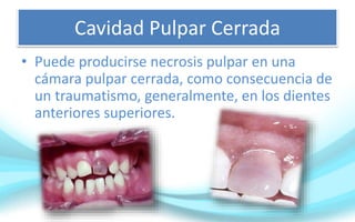Cavidad Pulpar Cerrada
• Puede producirse necrosis pulpar en una
cámara pulpar cerrada, como consecuencia de
un traumatismo, generalmente, en los dientes
anteriores superiores.
 