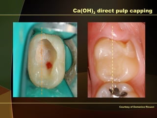 Pulp Caries Pulp rection to caries and restorative procedures.pptx