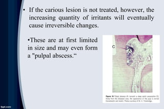 • If the carious lesion is not treated, however, the
increasing quantity of irritants will eventually
cause irreversible changes.
•These are at first limited
in size and may even form
a "pulpal abscess.“
 
