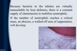 • Because bacteria in the tubules are virtually
unassailable by host defenses, there is a constant
supply of chemotaxins to mobilize neutrophils.
• If the number of neutrophils reaches a critical
mass, an abscess, a walled-off area of suppuration,
will develop.
 