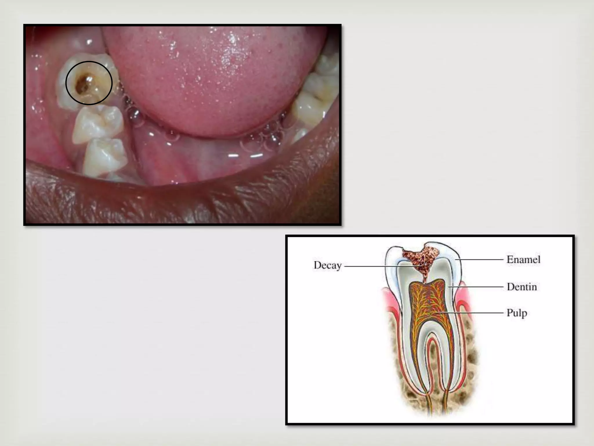 Pulpitis Priapical Pulpal & periapical diseases | PPTX