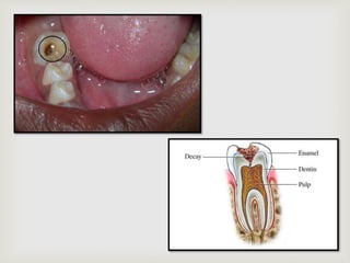 
Spread of infection to the apical
periodontal ligament region.
Clinical features
 Acute or chronic.
 Mild pain while c...