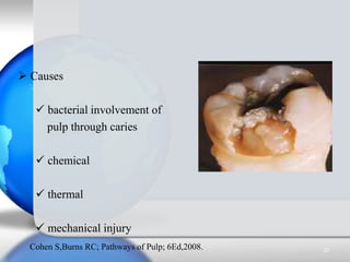  Causes
 bacterial involvement of
pulp through caries
 chemical
 thermal
 mechanical injury
20Cohen S,Burns RC; Pathw...