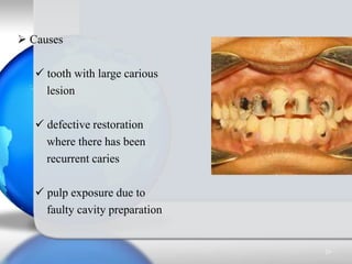  Causes
 tooth with large carious
lesion
 defective restoration
where there has been
recurrent caries
 pulp exposure d...