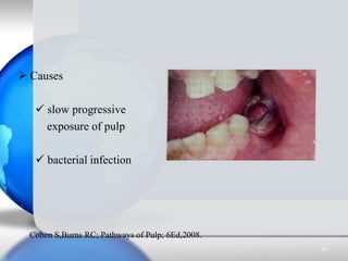  Causes
 slow progressive
exposure of pulp
 bacterial infection
Cohen S,Burns RC; Pathways of Pulp; 6Ed,2008.
38
 