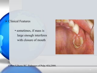  Clinical Features
• sometimes, if mass is
large enough interferes
with closure of mouth
Cohen S,Burns RC; Pathways of Pu...