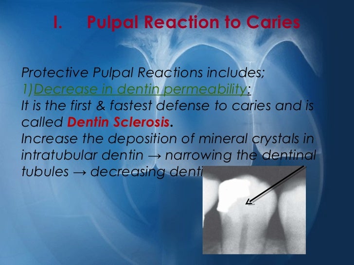 Pulpal reactions to caries and dental procedures