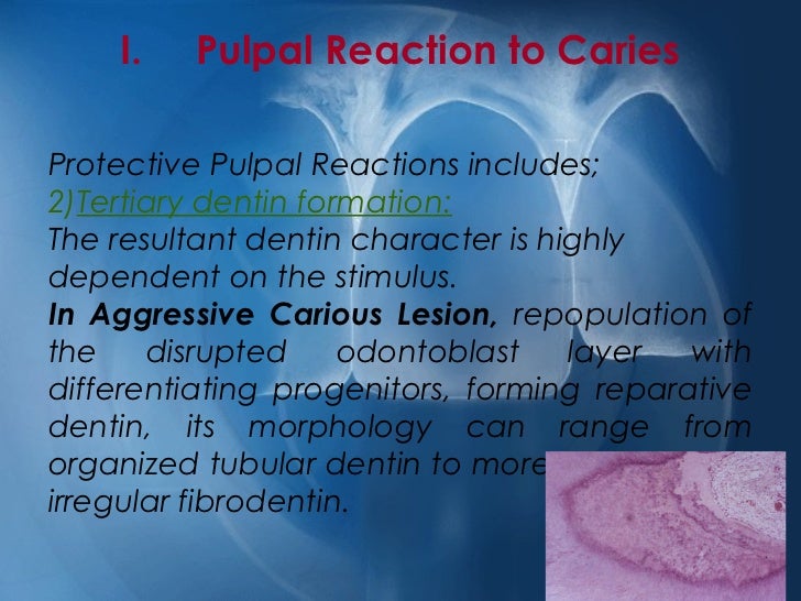 Pulpal reactions to caries and dental procedures