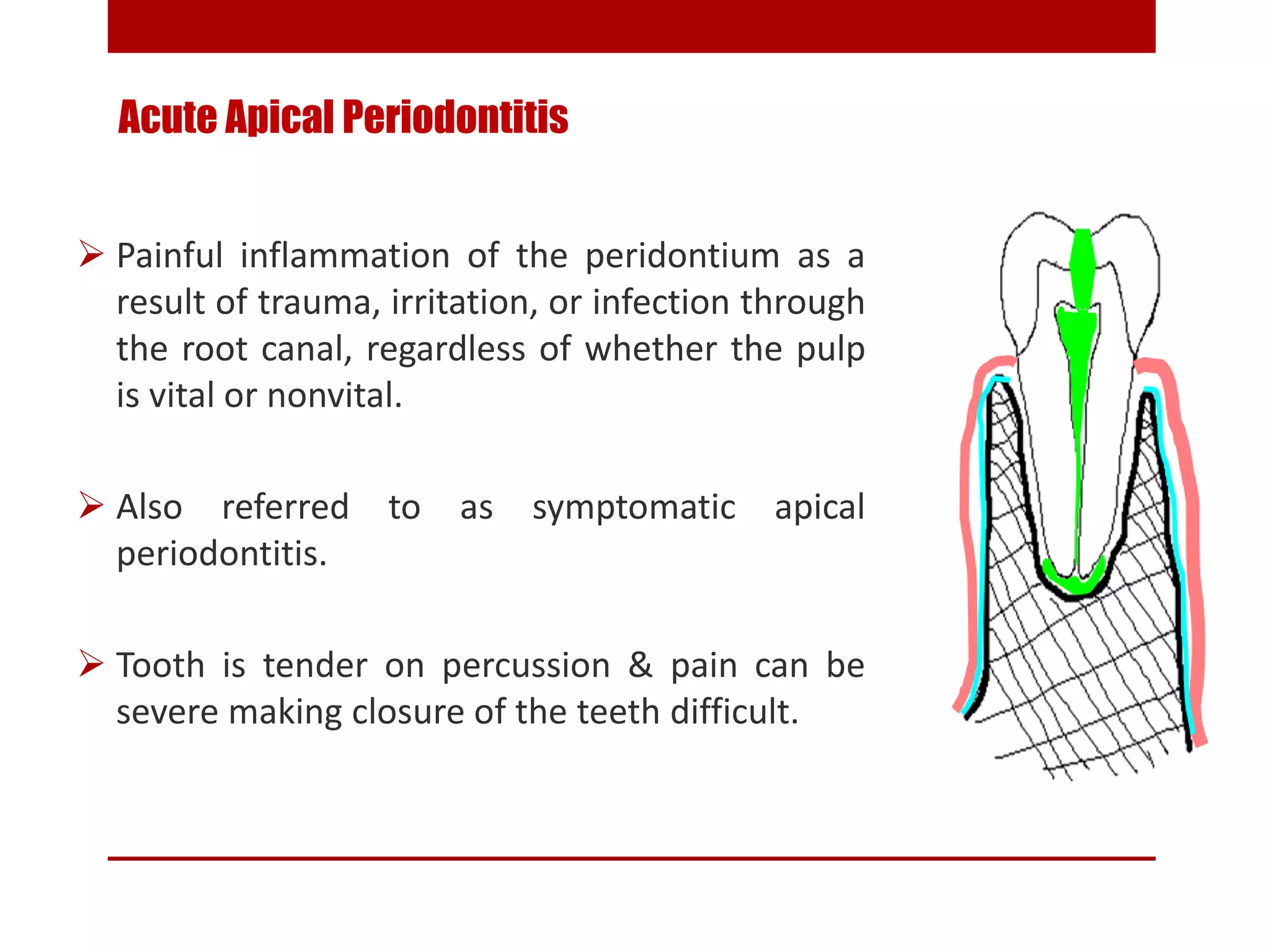 Pulpitis Priapical PULP AND PERIAPICAL LESIONS OF THE TOOTH ppt | PPTX
