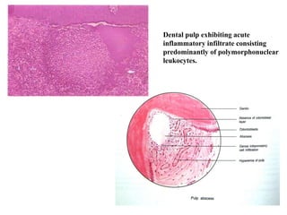 Dental pulp exhibiting acute
inflammatory infiltrate consisting
predominantly of polymorphonuclear
leukocytes.
 