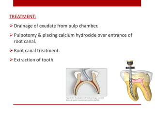 TREATMENT:
Drainage of exudate from pulp chamber.
Pulpotomy & placing calcium hydroxide over entrance of
root canal.
Ro...
