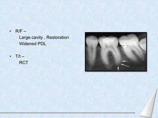 Pulp and periapical pathologies | PPTX