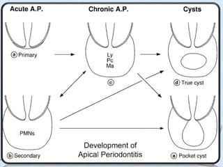 Acute apicalperiodontitis
• It is a painful inflammation of the periodontium as a result of trauma,
irritation, or infecti...