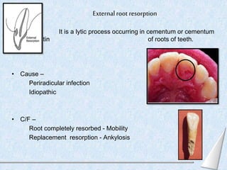 • R/F –
Scooped - out pattern of root
• D/d –
Internal resorption
• T/t –
Varies with etiologic agent
 