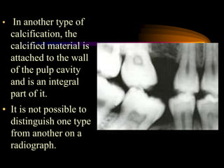 PULP AND PERIRADICULAR DISEASES.pptx
