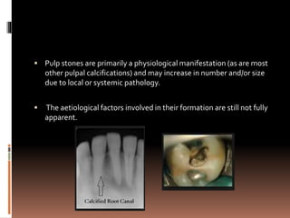  Pulp stones are primarily a physiological manifestation (as are most
other pulpal calcifications) and may increase in number and/or size
due to local or systemic pathology.
 The aetiological factors involved in their formation are still not fully
apparent.
 