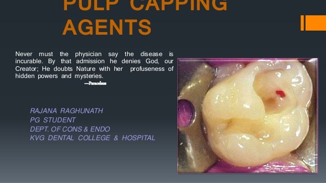 Pulp capping agents Pulp capping agents