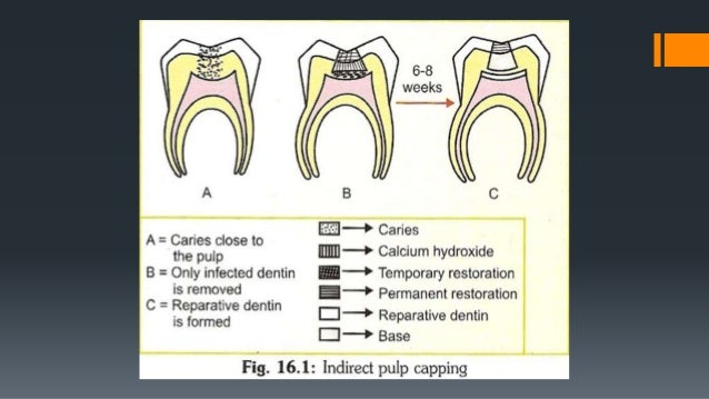 indirect pulp cap