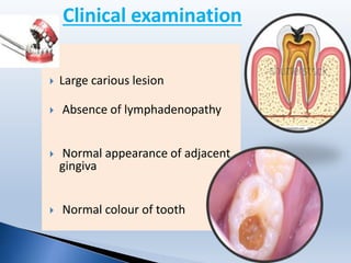  Large carious lesion
 Absence of lymphadenopathy
 Normal appearance of adjacent
gingiva
 Normal colour of tooth
Clinical examination
 