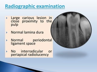  Large carious lesion in
close proximity to the
pulp
 Normal lamina dura
 Normal periodontal
ligament space
 No interradicular or
periapical radiolucency
 