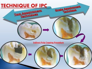 Indirect Pulp Capping Procedure
 