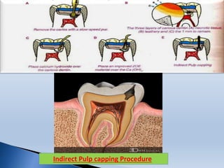 Indirect Pulp capping Procedure
 