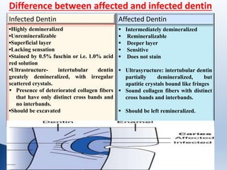 Infected Dentin
▪Highly demineralized
▪Unremineralizable
▪Superficial layer
▪Lacking sensation
▪Stained by 0.5% fuschin or i.e. 1.0% acid
red solution
▪Ultrastructure- intertubular dentin
greately demineralized, with irregular
scattered crystals.
 Presence of deteriorated collagen fibers
that have only distinct cross bands and
no interbands.
▪Should be excavated
Affected Dentin
 Intermediately demineralized
 Remineralizable
 Deeper layer
 Sensitive
 Does not stain
 Ultrasyructure: intertubular dentin
partially demineralized, but
apatitie crystals bound like fringes
 Sound collagen fibers with distinct
cross bands and interbands.
 Should be left remineralized.
Difference between affected and infected dentin
 