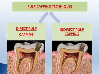 PULP CAPPING TECHNIQUES
INDIRECT PULP
CAPPING
DIRECT PULP
CAPPING
 