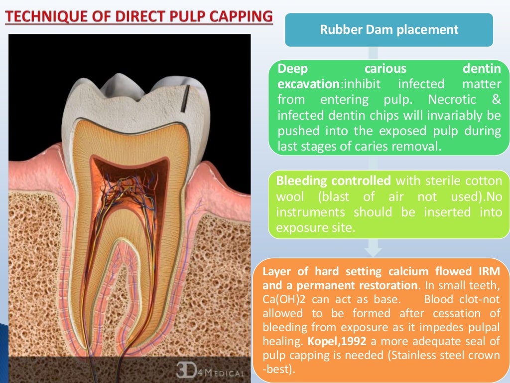 Pulp capping