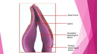 Primary
physiological
dentin
Secondary
physiological
dentin
Tertiary
dentin
Dead tracts
 