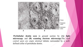Peritubular dentin seen in ground section by (A) light
microscopy and (B) scanning electron microscopy.The dark
central spots are empty dentinal tubules surrounded by a well-
defined collar of peritubular dentin.
 