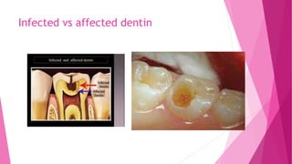 Infected vs affected dentin
 