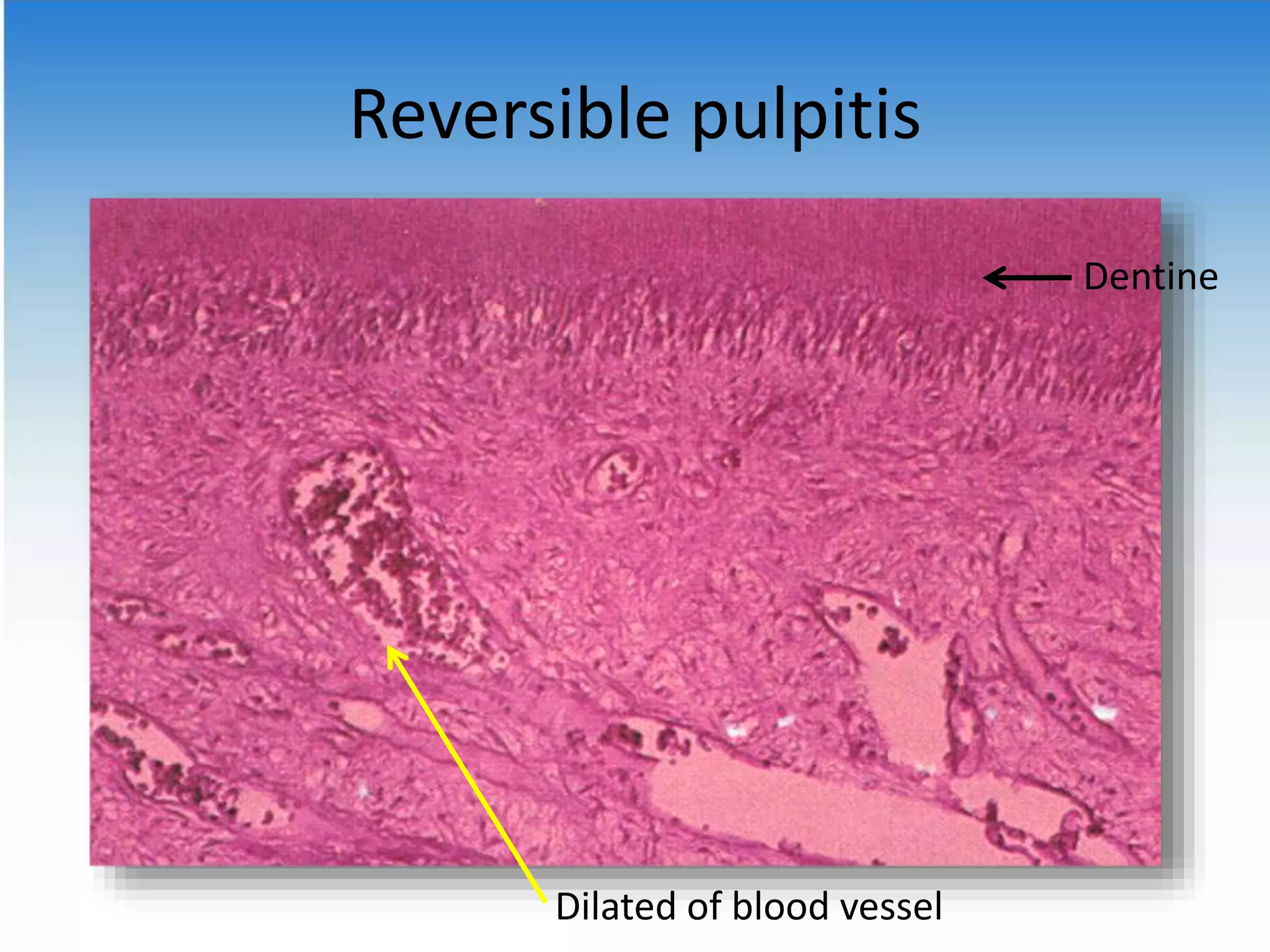 histopathology pulpitis reversible