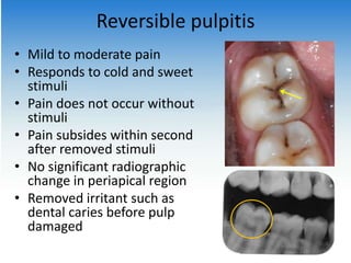Reversible pulpitis
• Mild to moderate pain
• Responds to cold and sweet
stimuli
• Pain does not occur without
stimuli
• Pain subsides within second
after removed stimuli
• No significant radiographic
change in periapical region
• Removed irritant such as
dental caries before pulp
damaged
 