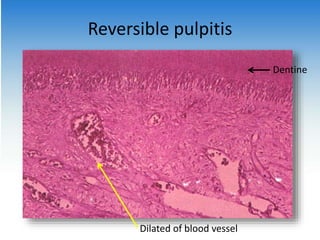 Reversible pulpitis
Dentine
Dilated of blood vessel
 