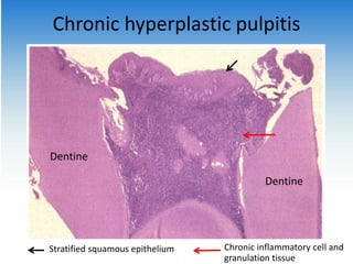 Chronic hyperplastic pulpitis
Dentine
Dentine
Stratified squamous epithelium Chronic inflammatory cell and
granulation tissue
 