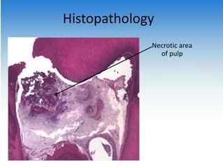Necrotic area
of pulp
Histopathology
 
