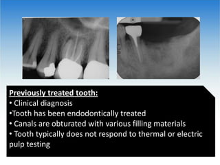 Previously treated tooth:
• Clinical diagnosis
•Tooth has been endodontically treated
• Canals are obturated with various filling materials
• Tooth typically does not respond to thermal or electric
pulp testing
 