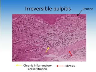 Irreversible pulpitis Dentine
FibrosisChronic inflammatory
cell infiltration
 