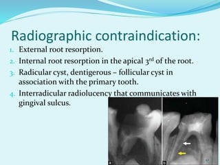 Interradicular Root Pulpectomy | PPTX