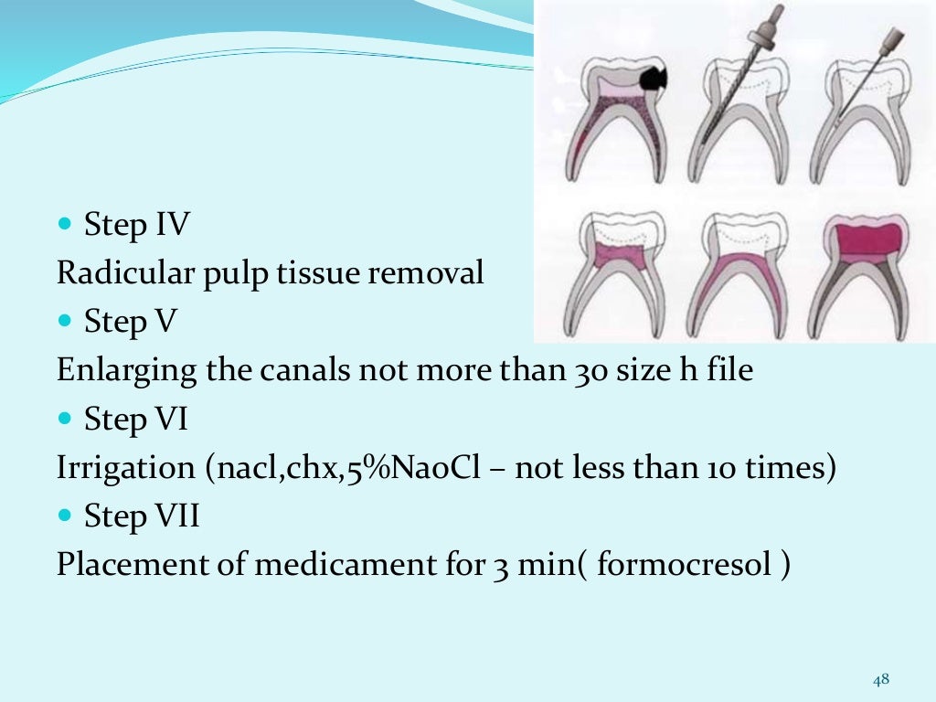 Pulpectomy