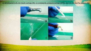 a) lentulospiral (LS); (b) insulin syringe (IS); (c) endodontic pressure syringe (EPS); and (d) the NaviTip system (NS)
 