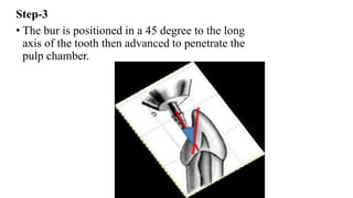 Step-3
• The bur is positioned in a 45 degree to the long
axis of the tooth then advanced to penetrate the
pulp chamber.
 