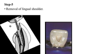 Step-5
• Removal of lingual shoulder.
 