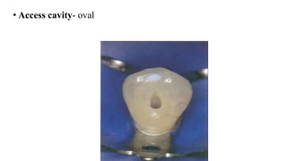 • Access cavity- oval
 