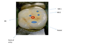 MB 1
MB 2
Palatal
Point of
entry
DB
 
