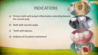 INDICATIONS
a) Primary teeth with pulpal inflammation extending beyond
the coronal pulp.
b) Teeth with necrotic pulps.
c) Teeth with abscess.
d) Evidence of furcation involvement
 